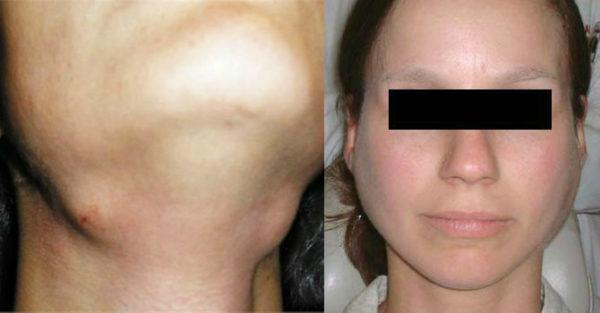 Как лечить сиаладенит