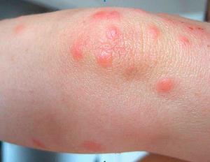 Как лечить сыпь на теле при ангине