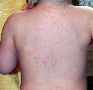 Как лечить сыпь на теле при ангине