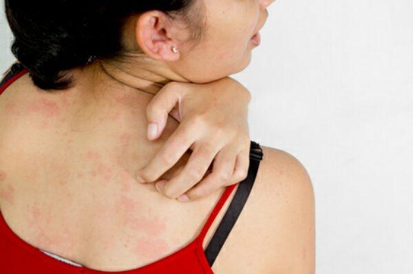 Как лечить сыпь на теле при ангине