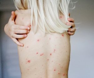 Как лечить сыпь на теле при ангине