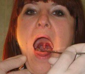 Как лечить воспаление язычка в горле