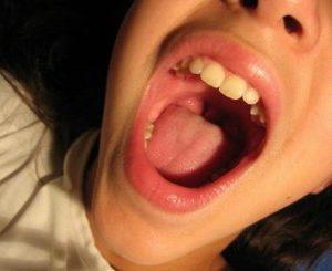 Как лечить воспаление язычка в горле