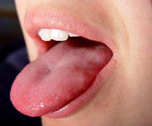 Как лечить воспаление язычка в горле