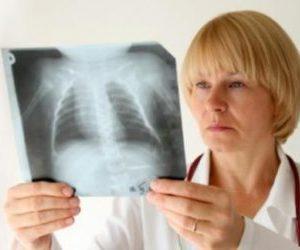 Как лечить воспаление лёгких