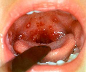 Как обезболить горло при ангине