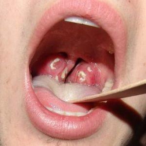 Как отличить ангину от тонзиллита
