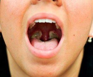 Как промыть миндалины