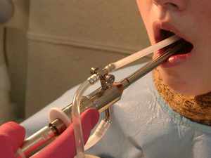 Как промыть миндалины