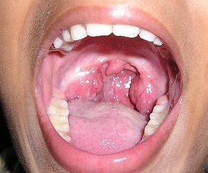 Как промыть миндалины