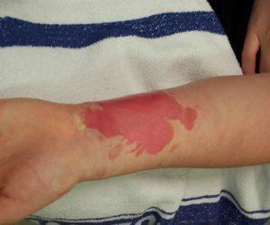 Как вылечить ожог от йода