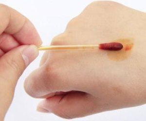 Как вылечить ожог от йода