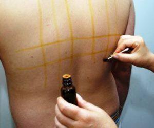 Как вылечить ожог от йода