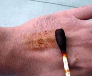 Как вылечить ожог от йода