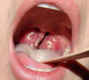 Какие ангины бывают