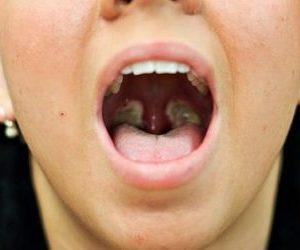 Какие ангины бывают