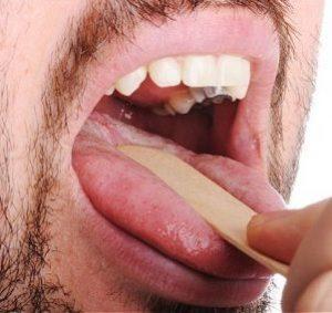 Лечение ангины гомеопатией