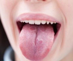 Лечение кандидоза полости рта