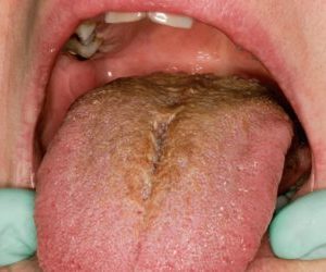 Лечение плохого запаха из горла