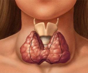 Лечение зоба щитовидной железы