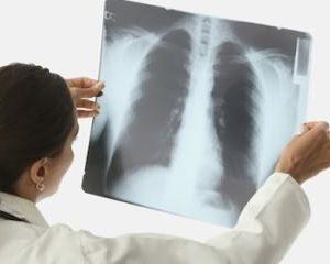 Может ли быть пневмония без кашля?