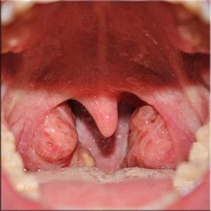 Как применять спрей для горла Орасепт