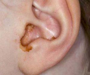Почему течет жидкость из уха и что делать?