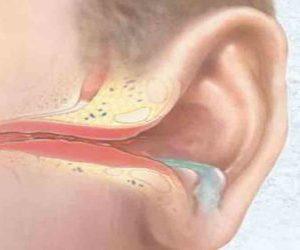 Почему течет жидкость из уха и что делать?