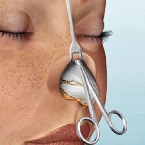 причины искривления носовой перегородки у детей