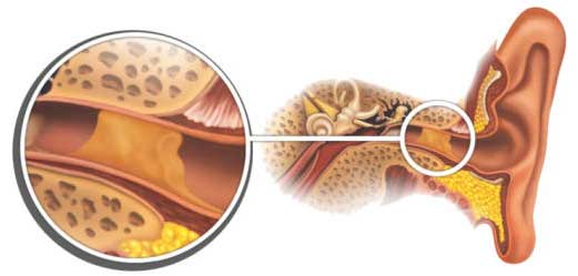 Причины и лечение пульсирующего шума в ухе.