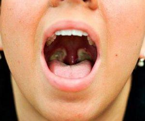 Удаление миндалин при хроническом тонзиллите у взрослых