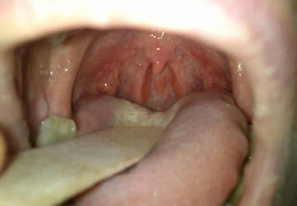 Удаление миндалин при хроническом тонзиллите у взрослых