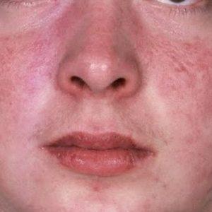 чешется вокруг носа