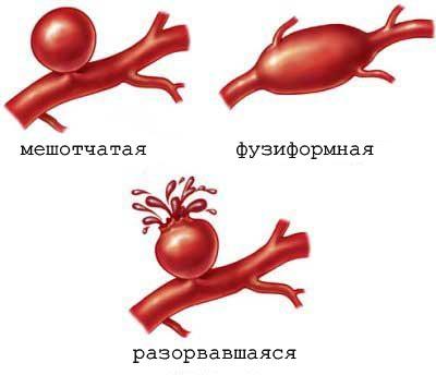 Причины и лечение пульсирующего шума в ухе.