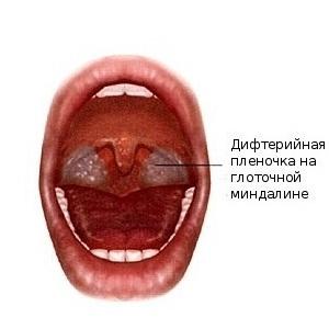 Чем отличается ангина от дифтерии