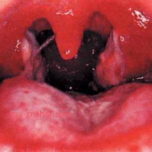 Чем отличается ангина от дифтерии