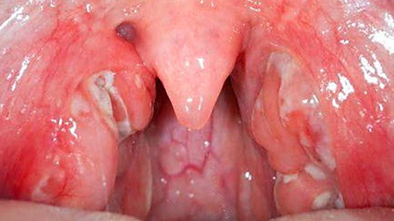 Как лечить тонзиллит в домашних условиях