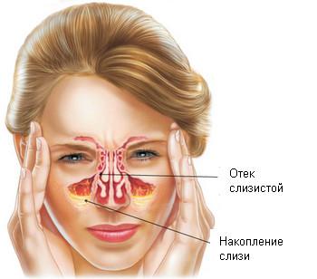 -гайморит прошел
