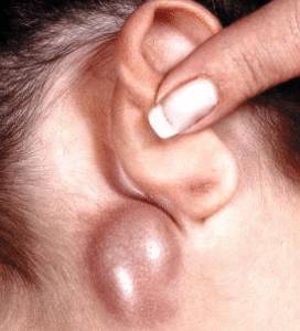 Что это если за ухом опухоль