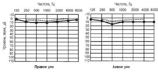 kak-audiogrammu-rasshifrovat'-slukha