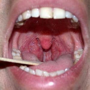 Как лечить вирусный тонзиллит