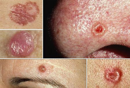 базалиома носа лечение