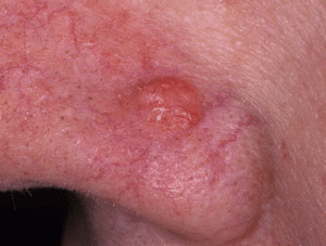 базалиома носа лечение