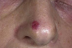 базалиома носа лечение