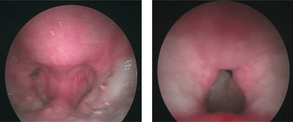разрастание слизистой носа