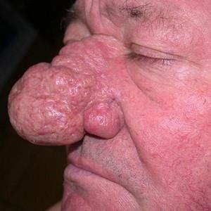 хронические заболевания носа