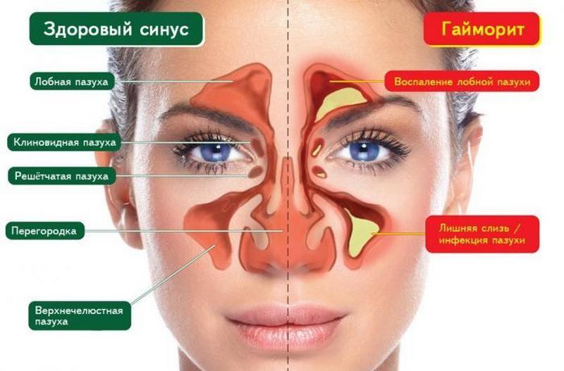 симптомы и лечение заболеваний носа
