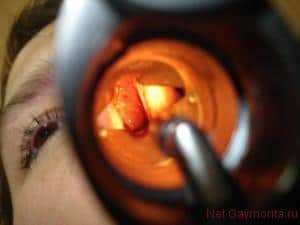 гипертрофия лимфоидной ткани носоглотки у взрослых