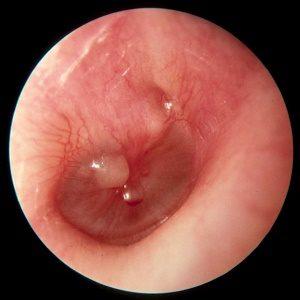 острый средний гнойный отит