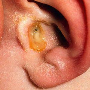 гнойный отит среднего уха